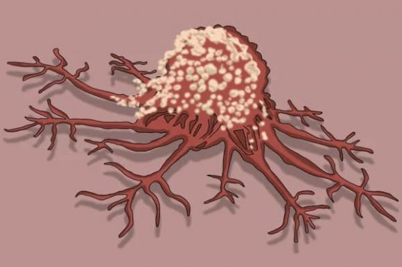 Điểm yếu của tế bào ung thư không phải là sợ tỏi hay súp lơ xanh mà là 5 thứ này, hầu hết ai cũng làm được-1