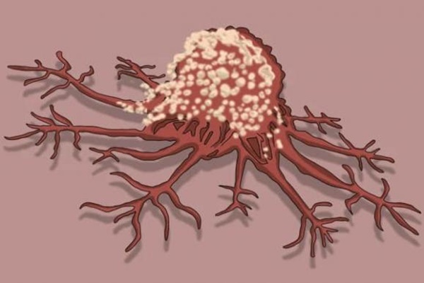 4 thực phẩm được chuyên gia đánh giá là sát thủ dễ gây ung thư ruột, hầu hết đều là món người Việt ăn mỗi ngày-4