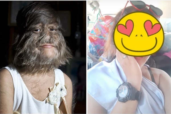 Gương mặt biến dạng vì khối u, bé gái bị hàng xóm bảo ra đường phải mang bao trùm đầu để rồi có màn vịt hóa thiên nga ngay ngày cưới-7