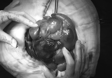 Phẫu thuật cứu bé gái 1 ngày tuổi mang khối u ổ bụng thai trong thai cực hiếm gặp-1