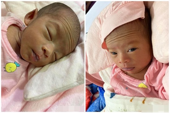 Bé gái Kiên Giang sinh non gầy guộc, da đen nhẻm, nhăn nheo như