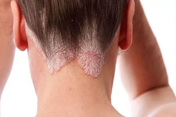 Thấy xuất hiện nhiều gàu ướt và bã nhờn trên tóc, coi chừng mắc căn bệnh ung thư dễ di căn não-1