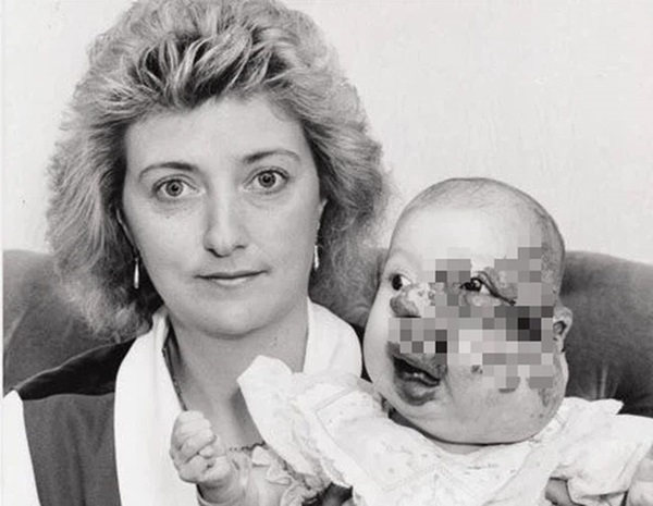 Gương mặt biến dạng vì khối u, bé gái bị hàng xóm bảo ra đường phải mang bao trùm đầu để rồi có màn vịt hóa thiên nga ngay ngày cưới-1