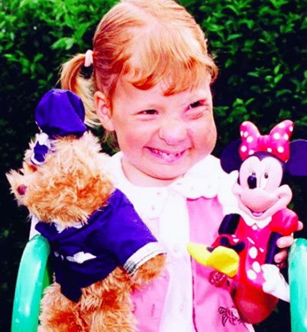 Gương mặt biến dạng vì khối u, bé gái bị hàng xóm bảo ra đường phải mang bao trùm đầu để rồi có màn vịt hóa thiên nga ngay ngày cưới-2