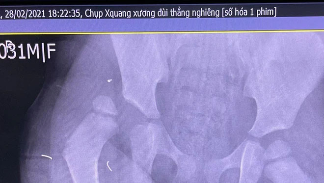 Hình ảnh CT não của cháu bé ngã từ tầng 13 chung cư không có tổn thương, BS thốt lên Tôi không thể tưởng tượng...-2