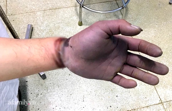 Cứu thanh niên gặp tai nạn kinh hoàng, cuộn kẽm siết chặt cổ tay đứt toàn bộ gân cơ duỗi-1