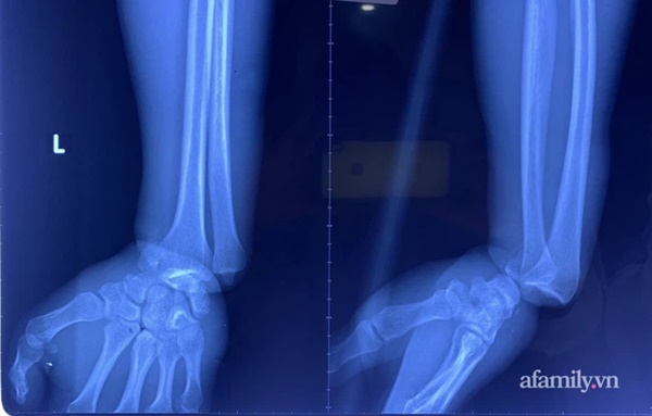 Cứu thanh niên gặp tai nạn kinh hoàng, cuộn kẽm siết chặt cổ tay đứt toàn bộ gân cơ duỗi-2