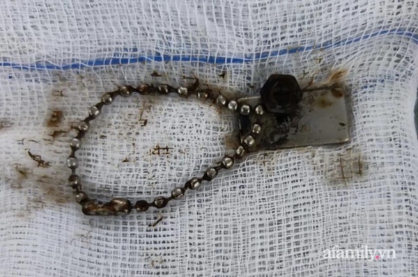 Bé trai 6 tuổi thủng ruột suýt chết do nuốt phải nam châm-3