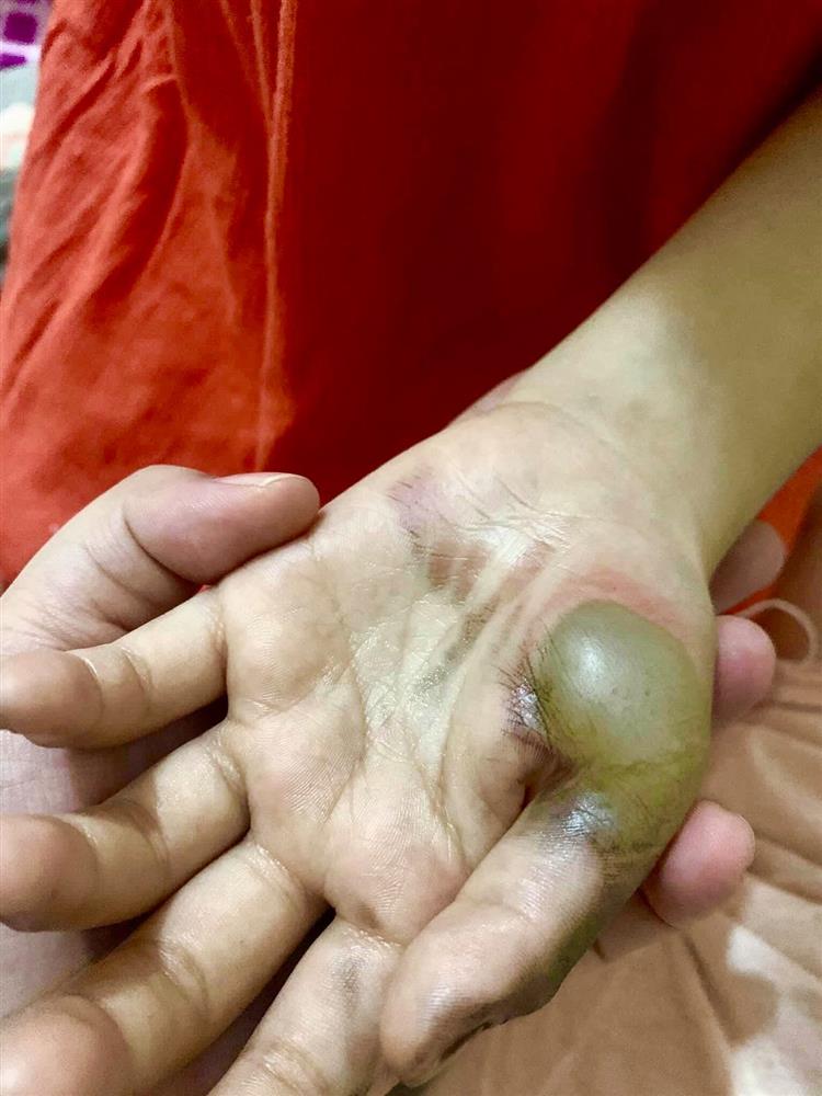 Phích cắm điện phát nổ khiến bàn tay bé gái cháy đen không thể cử động và lời cảnh báo với các phụ huynh có con nhỏ-2