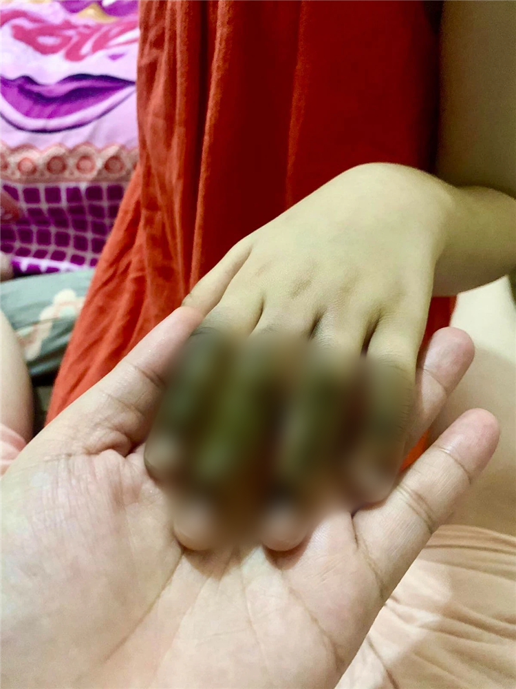 Phích cắm điện phát nổ khiến bàn tay bé gái cháy đen không thể cử động và lời cảnh báo với các phụ huynh có con nhỏ-3