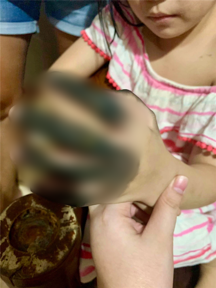 Phích cắm điện phát nổ khiến bàn tay bé gái cháy đen không thể cử động và lời cảnh báo với các phụ huynh có con nhỏ-4