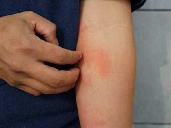 6 biến chứng lâu dài liên quan đến COVID-19-5