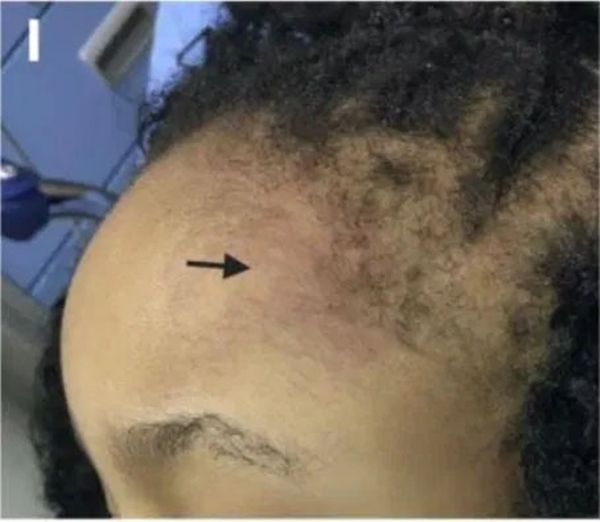 Cách phân biệt phát ban thông thường và phát ban liên quan tới COVID-19 ở trẻ-2