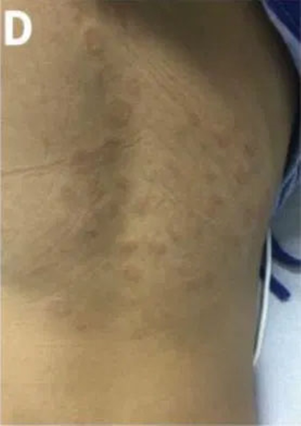 Cách phân biệt phát ban thông thường và phát ban liên quan tới COVID-19 ở trẻ-3