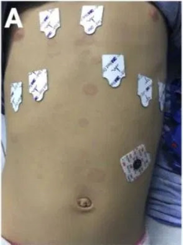 Cách phân biệt phát ban thông thường và phát ban liên quan tới COVID-19 ở trẻ-4