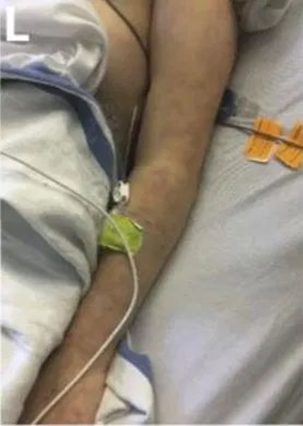 Cách phân biệt phát ban thông thường và phát ban liên quan tới COVID-19 ở trẻ-5