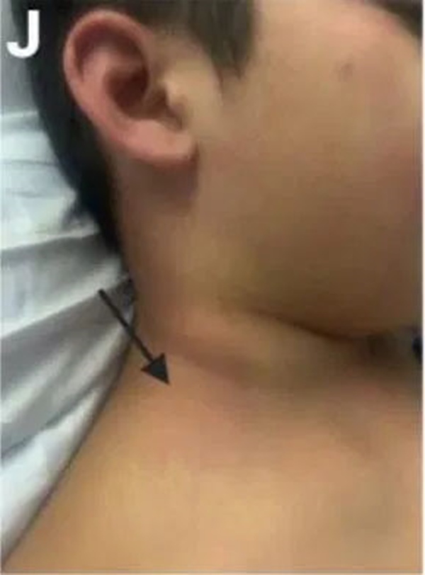 Cách phân biệt phát ban thông thường và phát ban liên quan tới COVID-19 ở trẻ-6