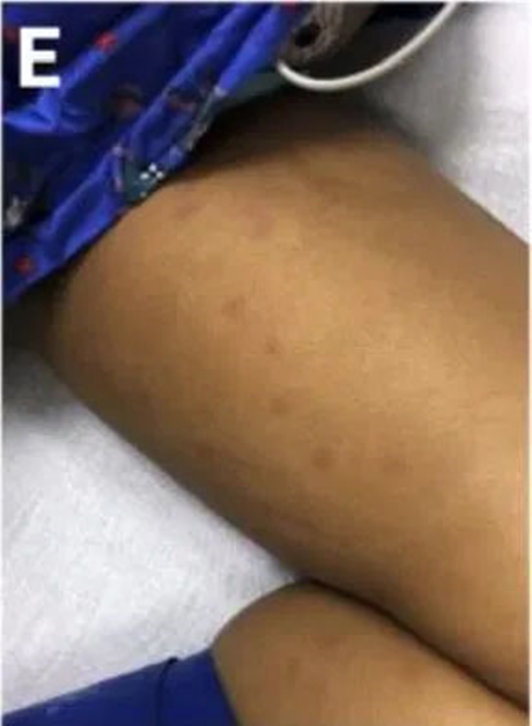 Cách phân biệt phát ban thông thường và phát ban liên quan tới COVID-19 ở trẻ-7