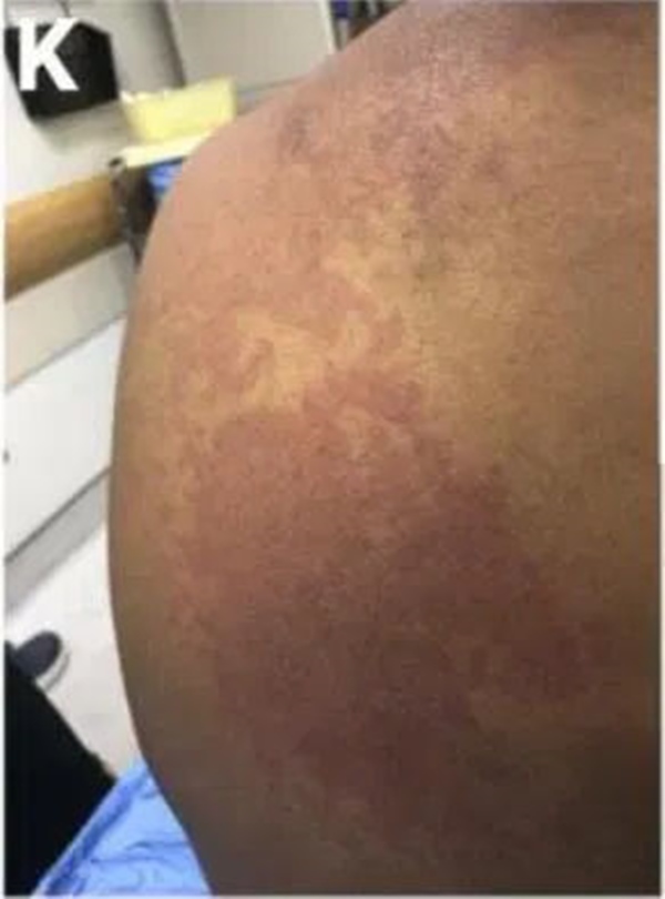 Cách phân biệt phát ban thông thường và phát ban liên quan tới COVID-19 ở trẻ-8