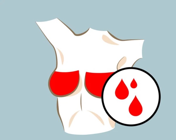 Nữ giới gặp phải 3 tín hiệu bất thường trong kỳ kinh nguyệt có thể là dấu hiệu cảnh báo sớm bệnh ung thư vú-2