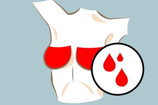 Nữ giới gặp phải 3 tín hiệu bất thường trong kỳ kinh nguyệt có thể là dấu hiệu cảnh báo sớm bệnh ung thư vú