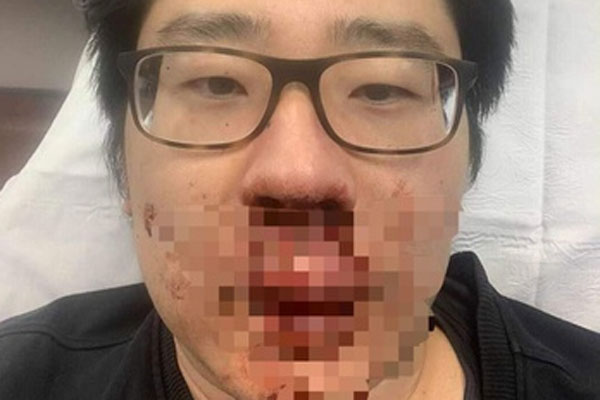 Người đàn ông bị rút cạn 2/3 lượng máu trong cơ thể, suýt chết vì 1 hành động chủ quan mà nhiều người mắc phải-4