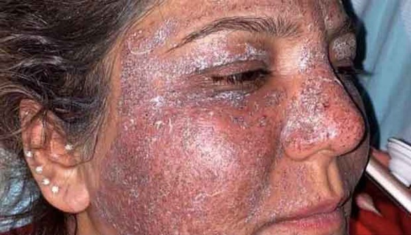 Đang từ xinh đẹp, người phụ nữ bỗng bị chảy mủ, sưng tấy khắp mặt vô cùng kinh hãi chỉ vì việc làm quen thuộc của rất nhiều chị em-1