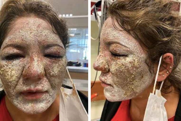 Đang từ xinh đẹp, người phụ nữ bỗng bị chảy mủ, sưng tấy khắp mặt vô cùng kinh hãi chỉ vì việc làm quen thuộc của rất nhiều chị em-2