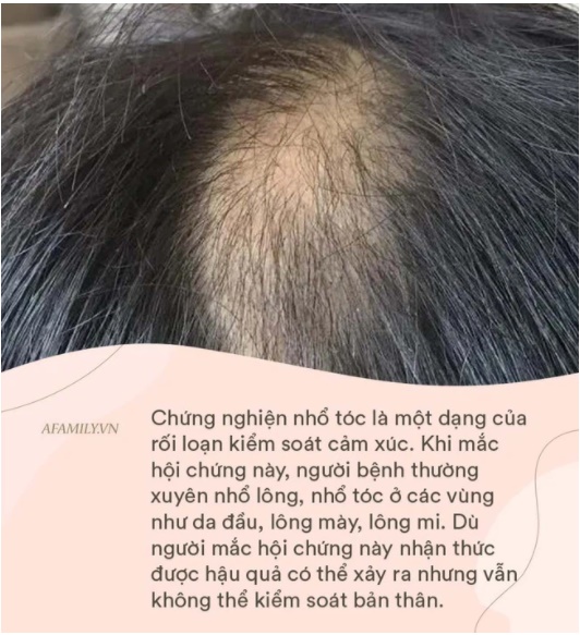 Con gái mới 9 tuổi đã bị hói đầu, bố mẹ đưa đi khám thì hối hận khi bác sĩ kết luận nguyên nhân-3