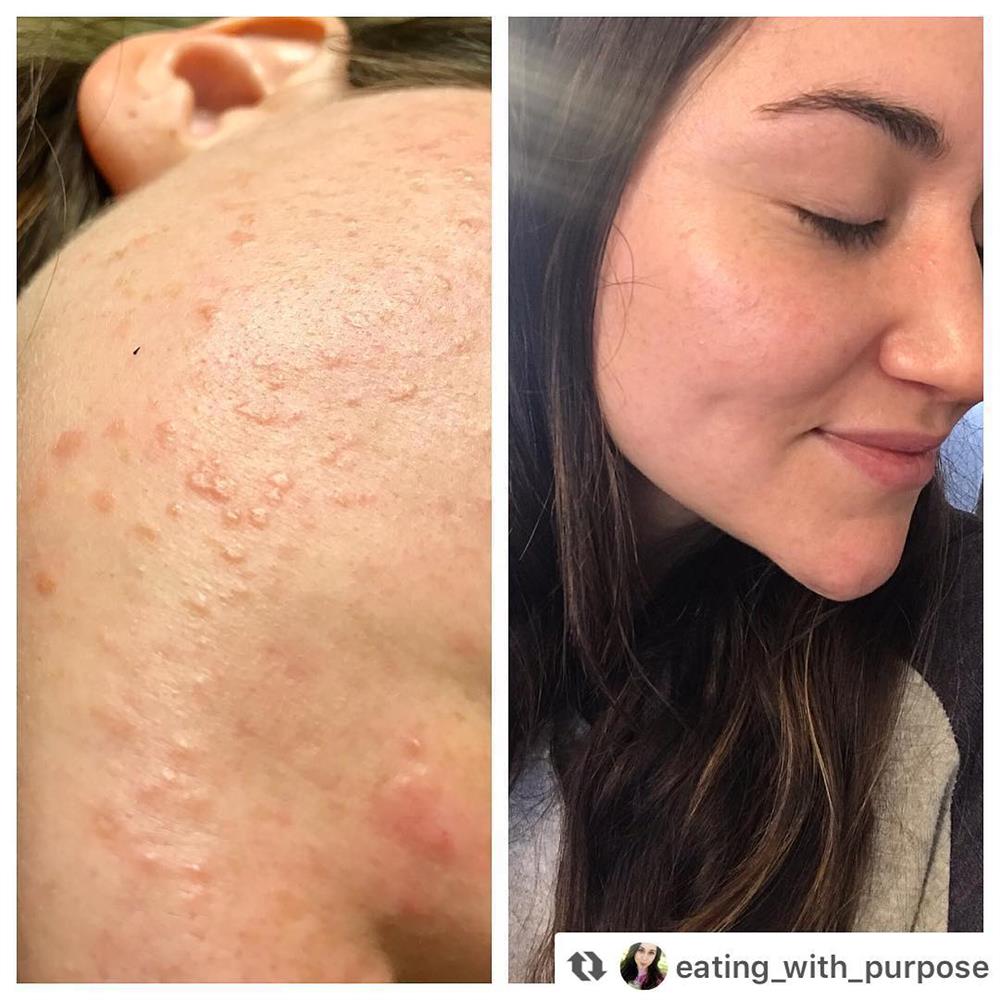 Chuyên gia Hàn Quốc chỉ rõ 5 lầm tưởng về vitamin C, chị em chớ nghe quảng cáo nếu không muốn da toang sau vài ngày sử dụng-6