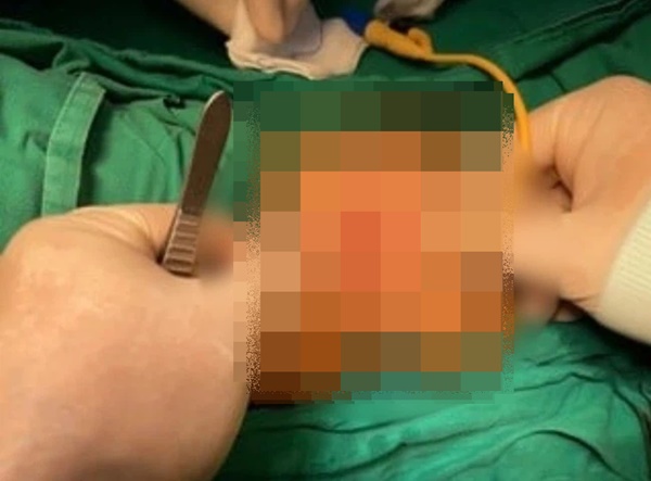Bé gái 8 tuổi ở Đà Lạt bất ngờ chảy máu vùng kín, phải xuống TP.HCM phẫu thuật vì căn bệnh hiếm gặp-1