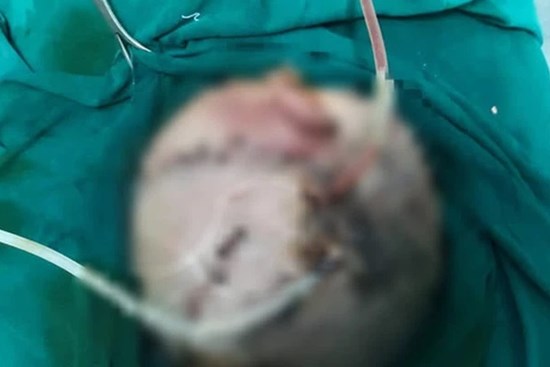 Bé trai hơn 4 tuổi bị chó nhà cắn tổn thương nặng vùng đầu