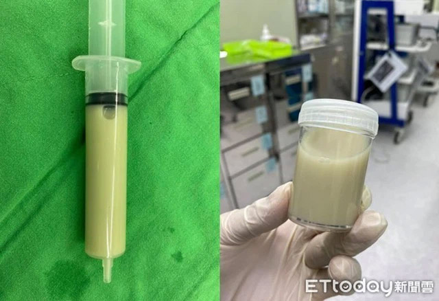 Đau vùng thắt lưng, mệt mỏi kéo dài 1 tháng, người phụ nữ được phẫu thuật hút ra nước tiểu có màu trắng sữa-2