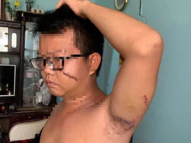 Nhắc nhở hàng xóm xây lấn chiếm vỉa hè, 2 mẹ con bị chém nhiều nhát vào mặt và cơ thể-2