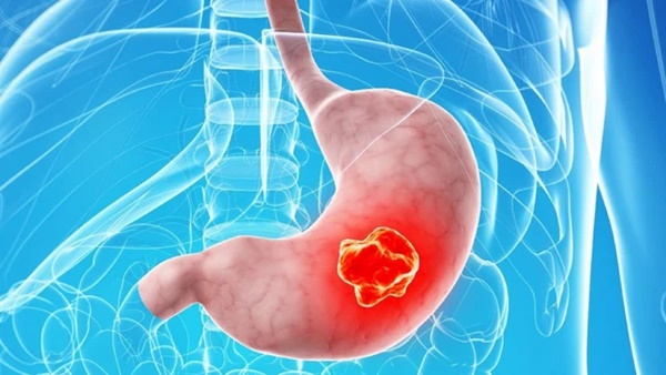 4 bệnh ung thư nguy hiểm nhất do thói quen ăn uống mà ra: Càng chậm thay đổi thì càng dễ mắc-1