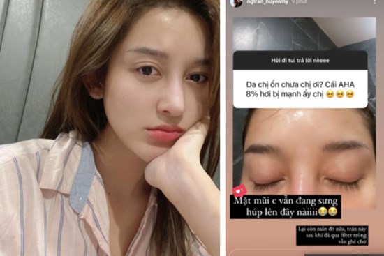 Làn da của Á hậu Huyền My