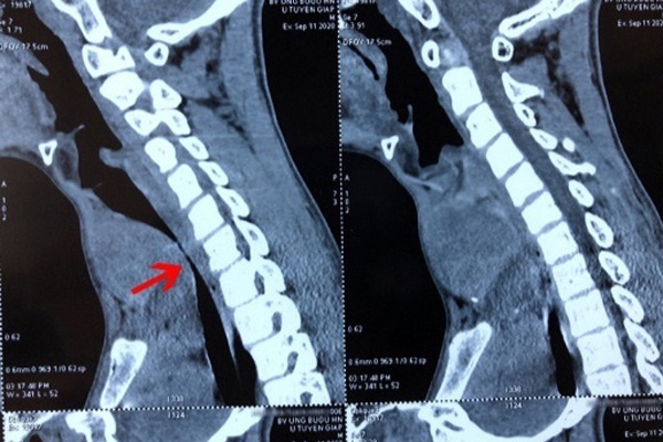 Thứ này ở trong bếp còn độc gấp 68 lần asen, dù tiếc bạn cũng phải vứt đi ngay kẻo ung thư ập đến-6