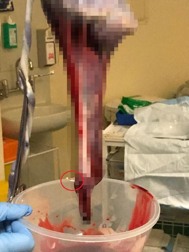 Đặt vòng tránh thai 3 năm sau phát hiện mình có bầu, nhưng vị trí của chiếc vòng tránh thai đi lạc mới khiến bà mẹ sửng sốt-1