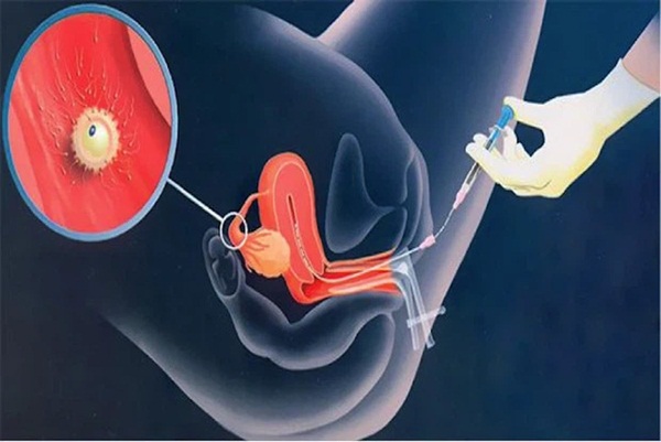 Cạm bấy chết người tại chợ đen mua bán trứng phụ nữ ở Trung Quốc: Nữ sinh đại học đánh cược cả tương lai để được sống hưởng nhất thời-4
