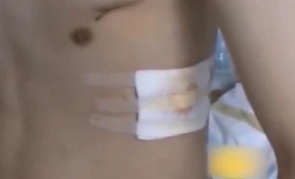 Vươn vai sau khi ngủ dậy, nam thanh niên nhập viện vì phổi tự phát nổ-4