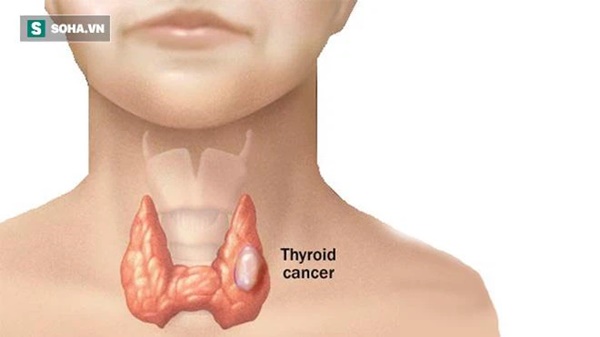 5 dấu hiệu cho thấy ung thư tuyến giáp đang lớn dần trong cơ thể-1