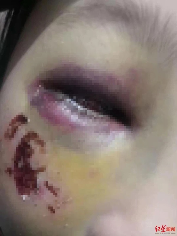 Bé gái 8 tuổi bị cô giáo đánh đến mức suýt mù chỉ vì làm Toán sai, hình ảnh được chia sẻ khiến phụ huynh phẫn nộ-2