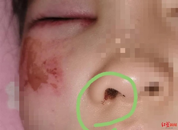 Bé gái 8 tuổi bị cô giáo đánh đến mức suýt mù chỉ vì làm Toán sai, hình ảnh được chia sẻ khiến phụ huynh phẫn nộ-3