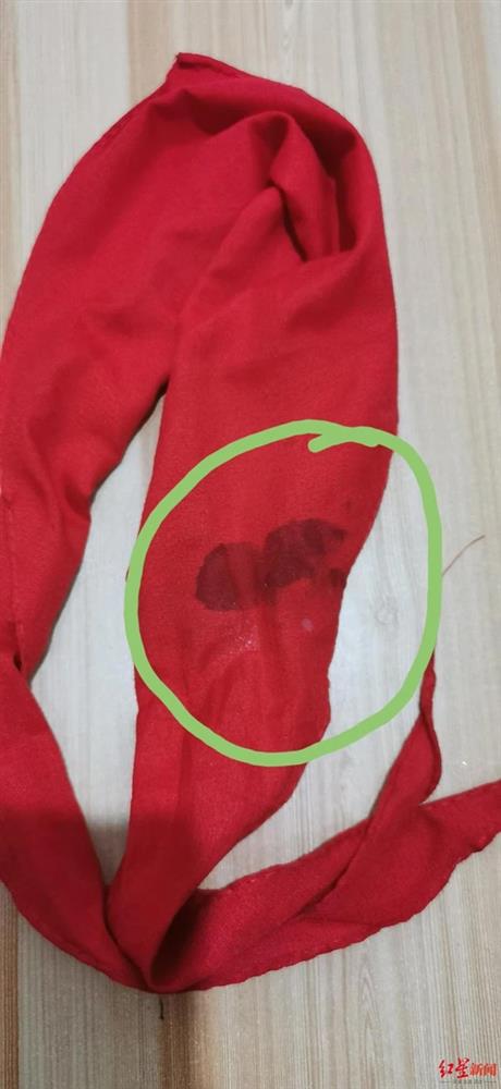 Bé gái 8 tuổi bị cô giáo đánh đến mức suýt mù chỉ vì làm Toán sai, hình ảnh được chia sẻ khiến phụ huynh phẫn nộ-4