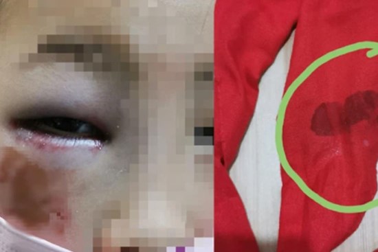 Bé gái 8 tuổi bị cô giáo đánh đến mức suýt mù chỉ vì làm Toán sai, hình ảnh được chia sẻ khiến phụ huynh phẫn nộ