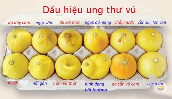 Một người mắc bệnh ung thư sẽ thấy 2 dấu vết kỳ lạ ở ngực, càng khám sớm thì cơ hội điều trị, sống sót càng cao-3