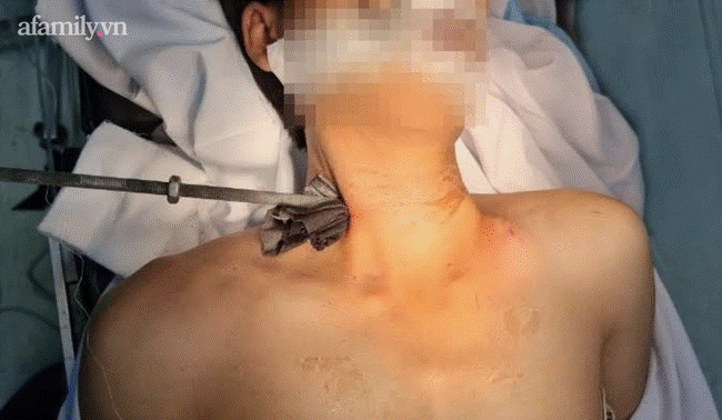 Tai nạn kinh hoàng: Đang sửa máy lạnh thì trượt chân, nam thanh niên bị thanh sắt dài 30cm đâm xuyên cổ nguy kịch-1