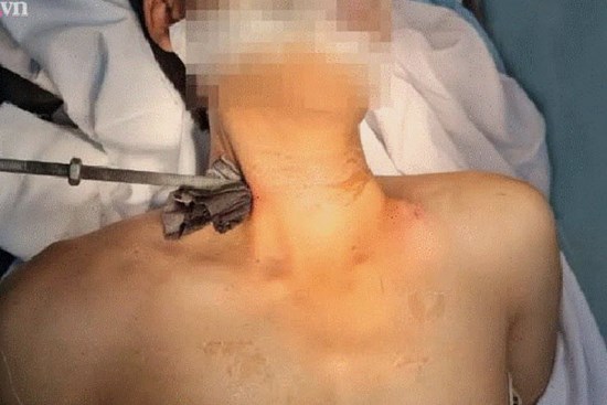 Tai nạn kinh hoàng: Đang sửa máy lạnh thì trượt chân, nam thanh niên bị thanh sắt dài 30cm đâm xuyên cổ nguy kịch