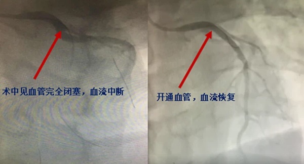 Chàng trai 27 tuổi suýt mất mạng do bị nhồi máu cơ tim 2 lần/tháng chỉ vì những thói quen xấu-1