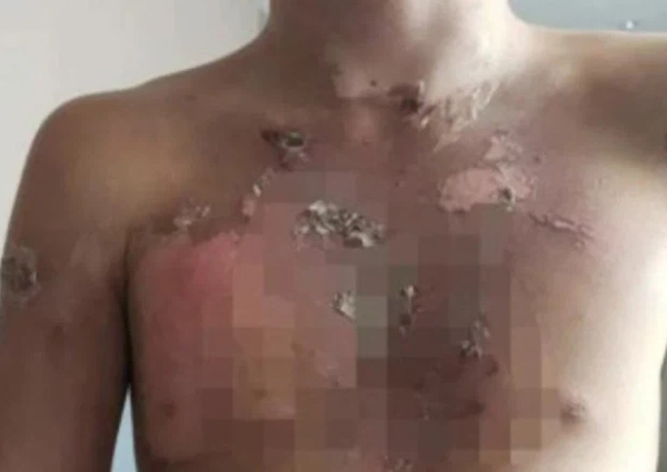 5 cậu bé 10 tuổi bị bạo hành dã man liên tục bằng nước sôi, hình ảnh vết thương và danh tính 2 kẻ ác gây căm phẫn tột độ-1